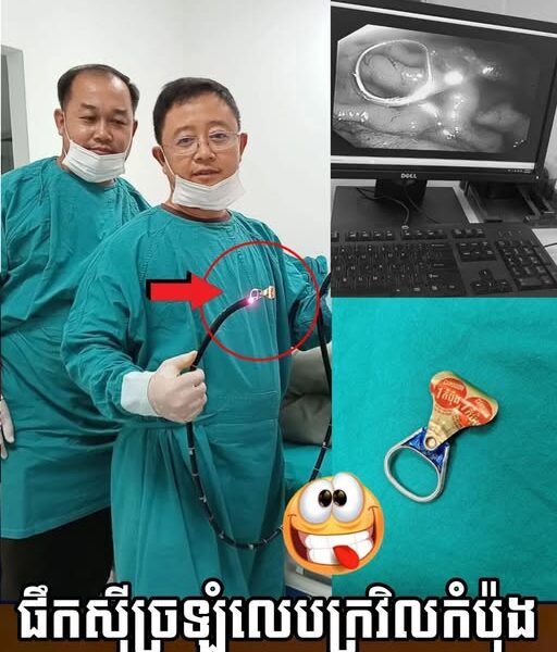 រំភើបពេកភ្លេចខ្លួន! ឈ្នះរង្វាន់ពីក្រវិលកំប៉ុងស្រាបៀរ ច្រឡំលេបចូលពោះ ផ្អើលដល់គ្រូពេទ្យជួយសង្គ្រោះបន្ទាន់…